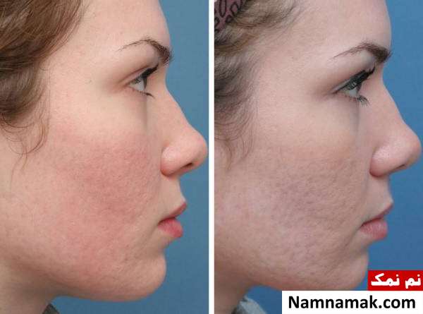 مضرات سابسیژن عوارض احتمالی سابسیژن