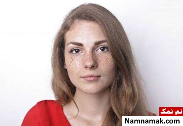 تیره شدن کک و مک پوست در بارداری