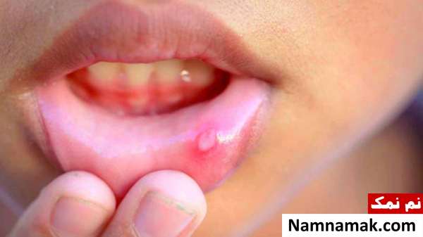 بیماری های مرتبط با بار زبان