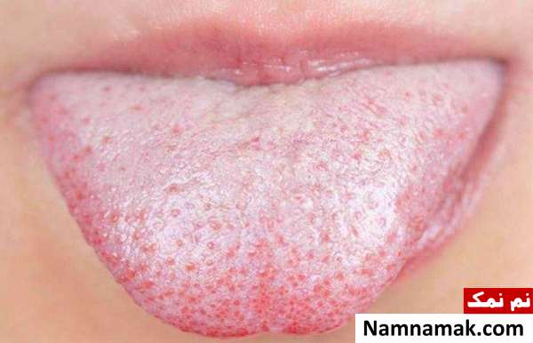 بار زبان چیست و درمان آن چگونه است؟