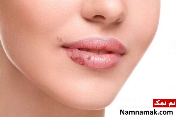 تبخال دهانی ایدز نشانه ایدز در دهان