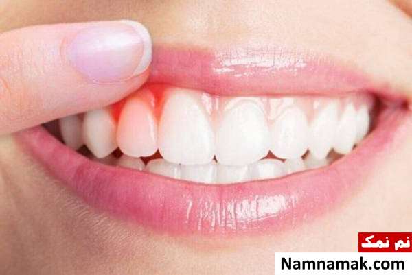 خونریزی لثه خونریزی لثه در بیماری ایدز