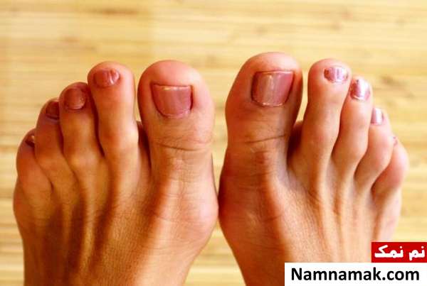 پا چکشی علائم بیماری های پا
