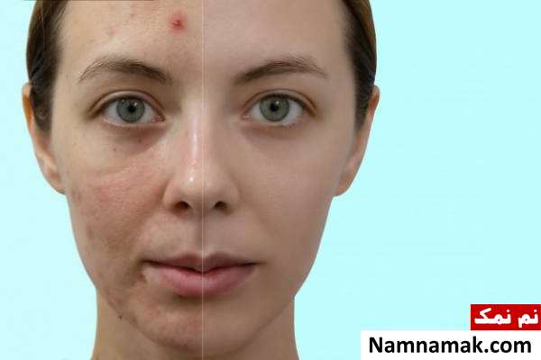 آکنه های شدید درمان جوش های شدید صورت