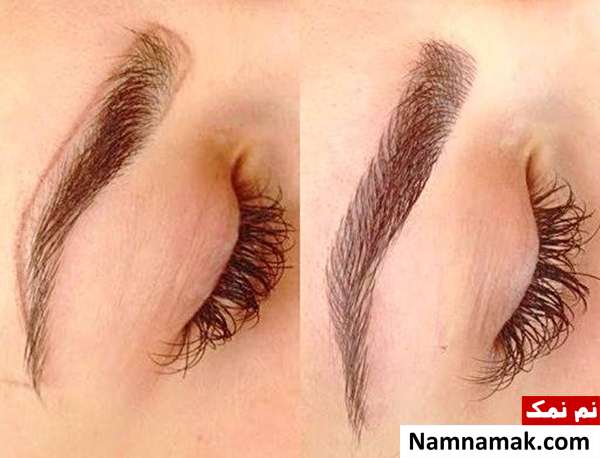 فیبروز ابرو معایب و مزایای فیبروز ابرو
