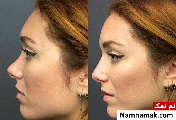 تفاوت فیلر بینی با عمل زیبایی بینی