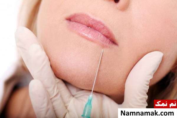 تزریق ژل به چانه 