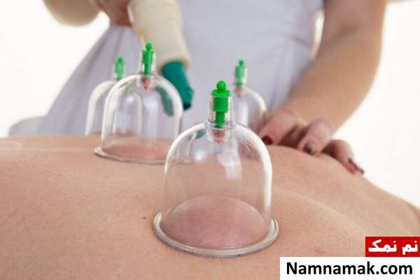 استفاده از بادکش برای لاغری