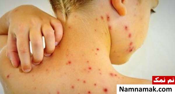 بیماری زونا احتمال ابتلا به زونا در چه کسانی بیشتری است؟