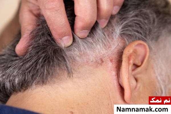 علت درماتیت سبورئیک