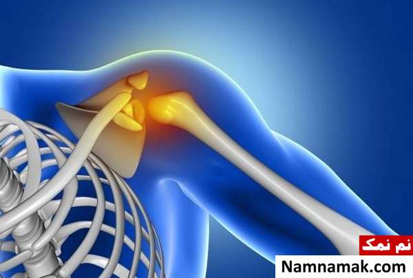 سندرم شانه یخ زده علت و علائم شانه یخ زده