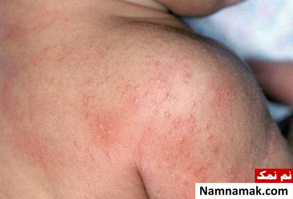 نشانه های گرمازدگی نوزادان