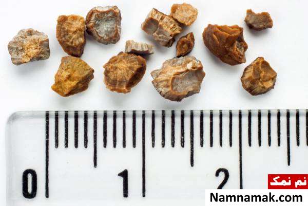 انواع سنگ کلیه 