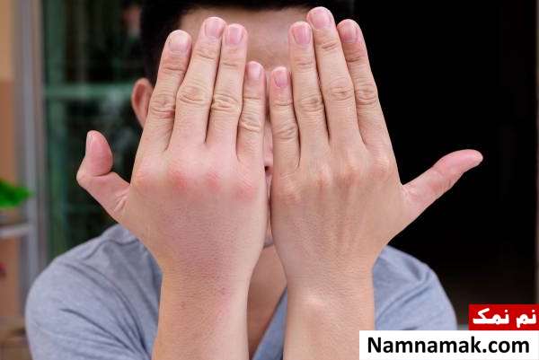 علل ورم دست و پا ورم دست و پا چه علتی دارد؟