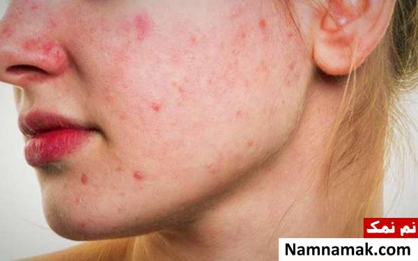 آکنه و جوش صورت رابطه شکلات و جوش