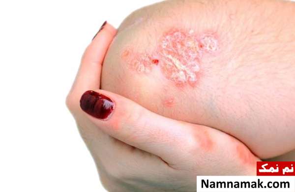 ایجاد ترک روی زبان به دلیل پسوریازیس پوسچولار