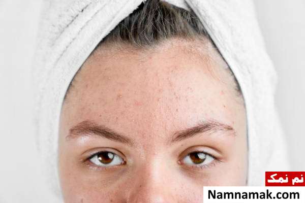 جوش های گرمایی درمان جوش های گرمایی