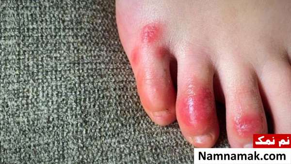 مشکلات پوستی کرونا نشانه های انگشت کوویدی