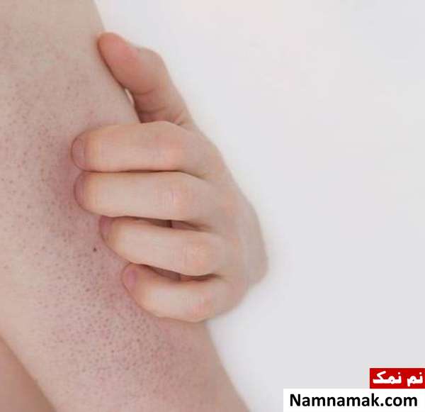 درمان خانگی جوش روی بازو 