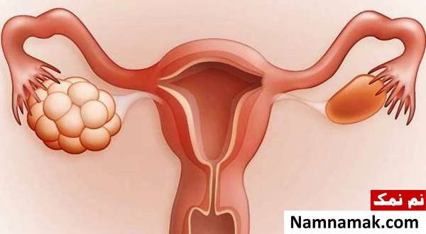 تنبلی تخمدان تخمدان پلی کیستیک