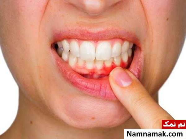 آنتی بیوتیک برای آبسه دندان