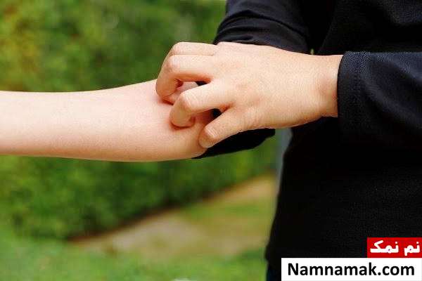حساسیت بابونه