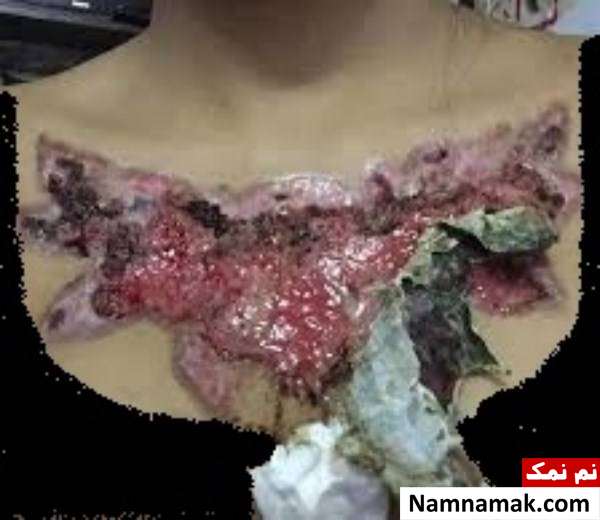 عاقبت تاتو روی سینه