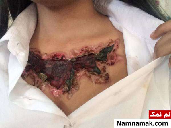 عکس وحشتناک پاک کردن تاتو