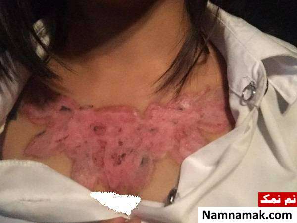 تمیز کردن تاتو روی سینه