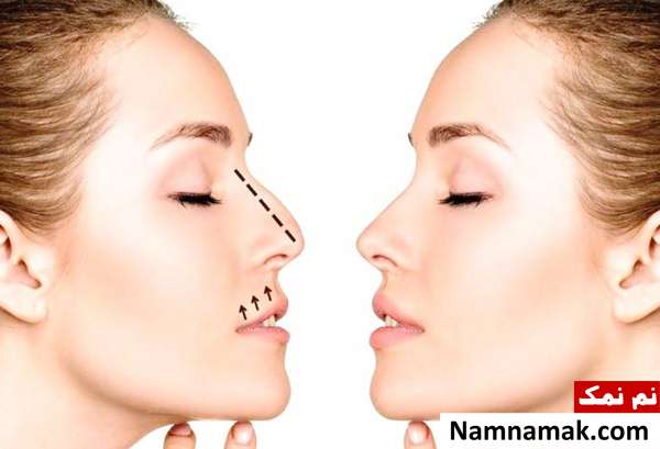 نحوه عمل بینی با لیزر نحوه کوچک شدن بینی با لیزر