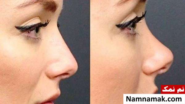 عمل زیبایی نوک بینی