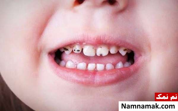 جلوگیری از تغییر رنگ دندان درمان تغییر رنگ دندان