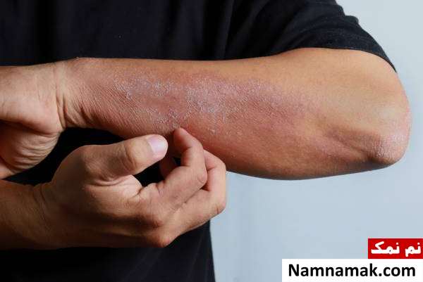 اشتباهات مرگباری که افراد در کمک های اولیه انجام میدهند! کمک های اولیه آلرژیک