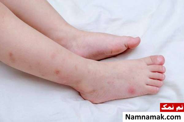 اشتباهات مرگباری که افراد در کمک های اولیه انجام میدهند! نگهداری کنه برای معالجه