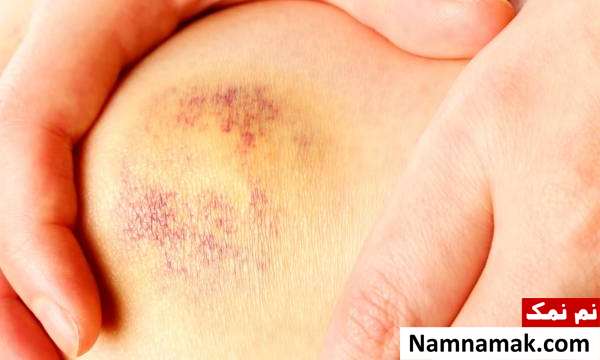 علل و علائم هماتوم + تغذیه و درمان گیاهی انباشت خون علائم هماتوم