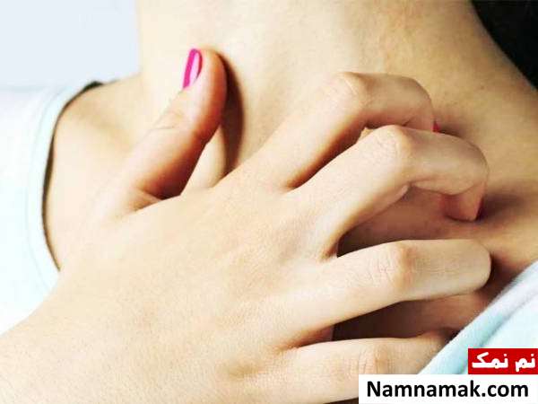 علت کهیر زدن پوست زیر نور آفتاب + راه حل خارش گردن بر اثر آفتاب
