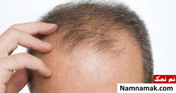 8 روش فوق العاده برای درمان ریزش موی شقیقه ها در زنان و مردان درمان ریزش مو در شقیقه ها