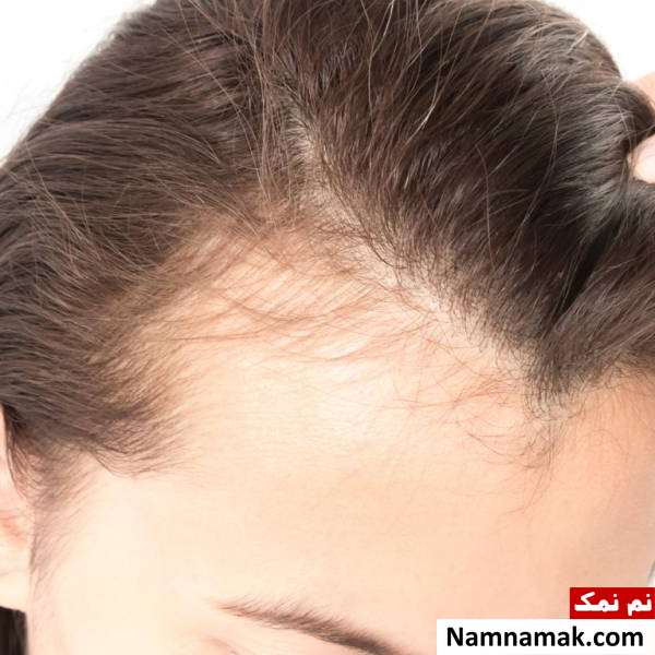 8 روش فوق العاده برای درمان ریزش موی شقیقه ها در زنان و مردان علل و درمان ریزش موی شقیقه ها