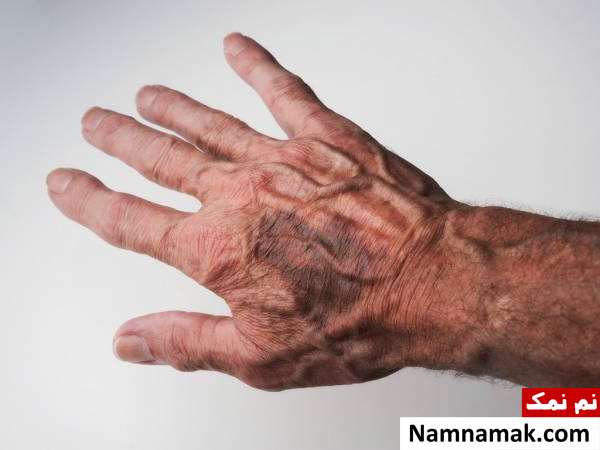 علل و علائم هماتوم + تغذیه و درمان گیاهی انباشت خون هماتوم در افراد سن بالا