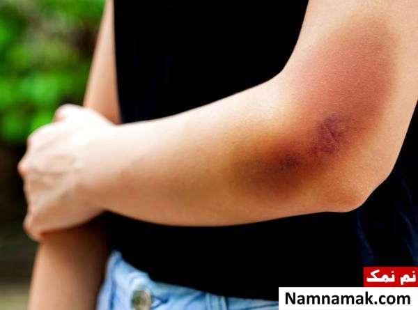 علل و علائم هماتوم + تغذیه و درمان گیاهی انباشت خون how to treat a hematoma