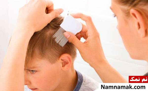 انواع ریزش مو در کودکان