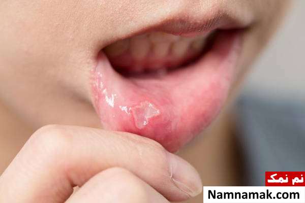 آفت دهان از دلایل سوزش زبان
