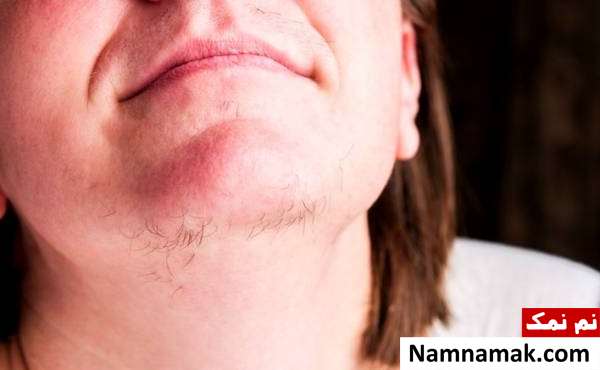 روش عالی رفع موهای زائد چانه با طب سنتی علت موهای زائد چانه