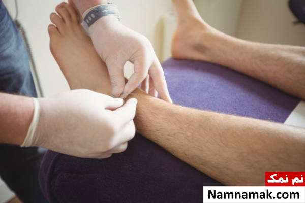 آموزش درای نیدلینگ
