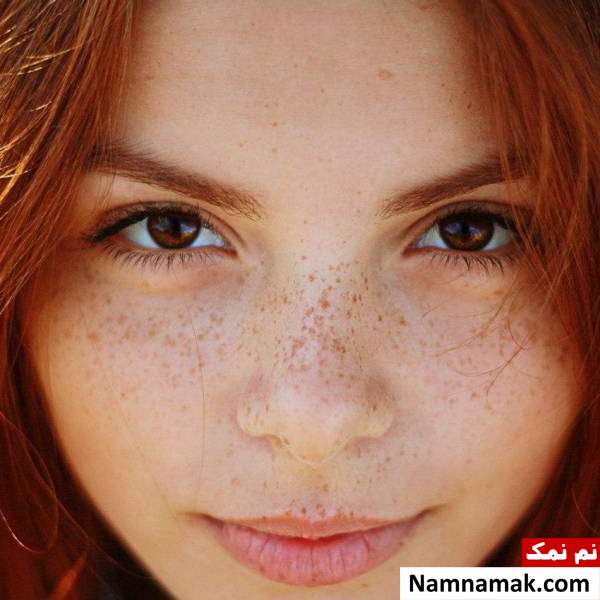 درمان ملاسما با روش های خانگی + انواع و علل ملاسما روی پوست درمان بیماری ملاسما