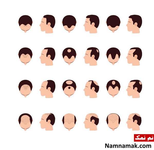 ریزش مو مردان|علت ریزش مو مردان و درمان ریزش مو علت ریزش مو مردان و درمان