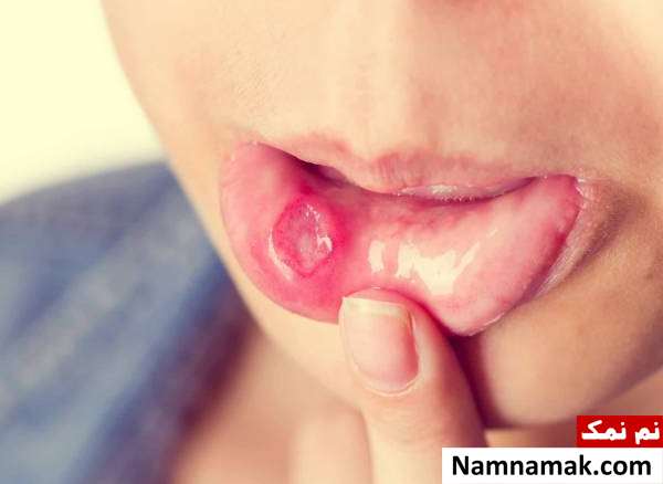 تشخیص سلامت از دهان ؛ علائم خطر داخل دهان تشخیص آفت دهان