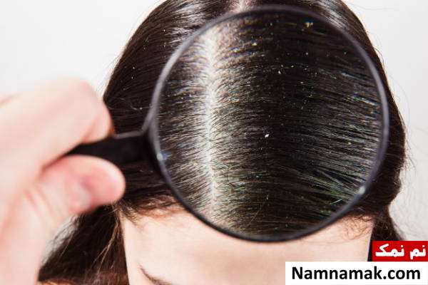 معرفی انواع شوره سر و بدترین آنها دلایل ایجاد شوره سر