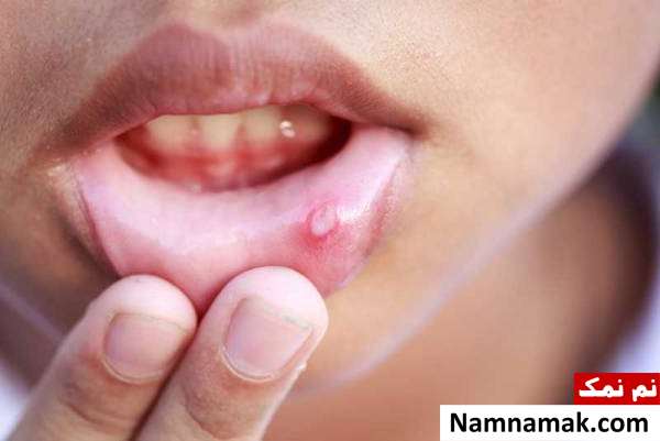 خطرات جویدن ناخن و 6 روش برای ترک این عادت تبخال زدن با جویدن ناخن