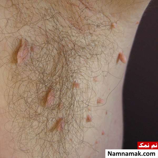 زگیل زیر بغل نشانه زگیل زیر بغل نشانه